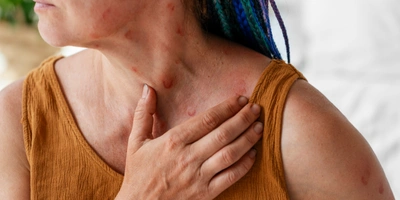 Anaphylaxis
